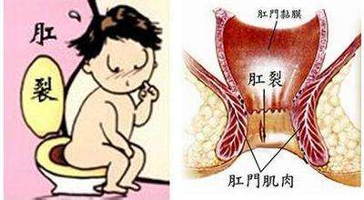 厦门治疗肛裂去哪家医院好