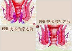 治疗痔疮，来厦门新开元医院